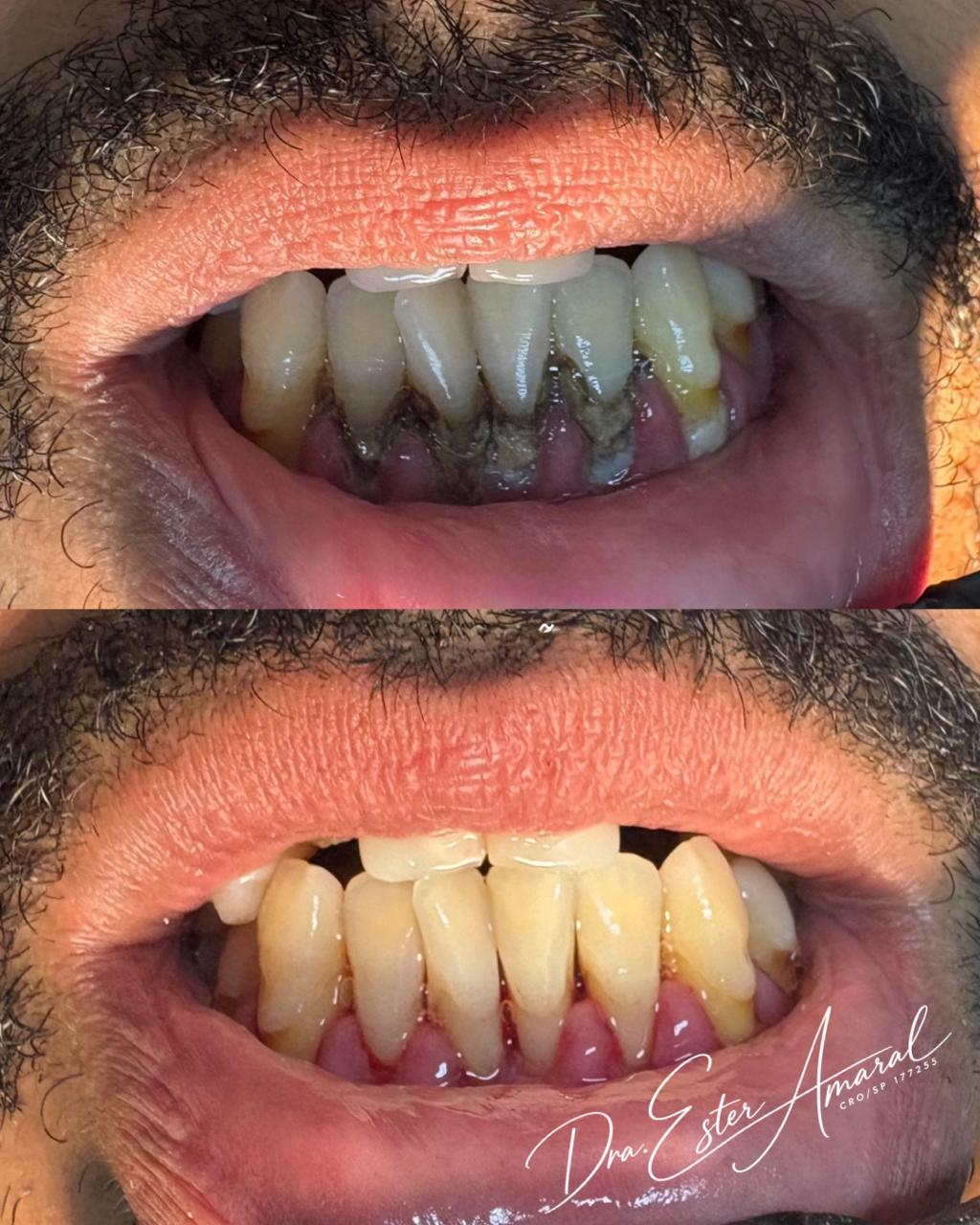 Caso clínico de Cuidado periodontal — antes e depois