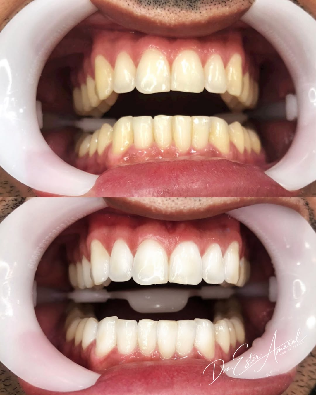 Caso clínico de Clareamento dental — antes e depois