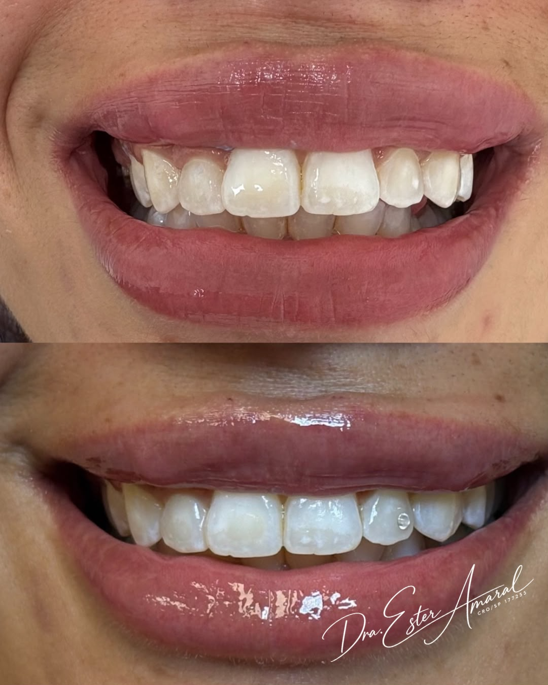 Caso clínico de Estética do sorriso — antes e depois